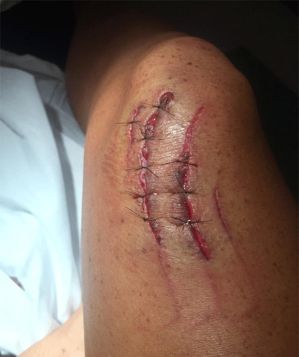 bike chain injury